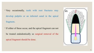 SEMINAR 10 - Horizontal root fractures.pptx