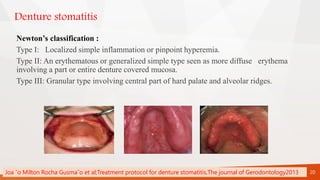 Denture stomatitis
Newton’s classification :
Type I: Localized simple inflammation or pinpoint hyperemia.
Type II: An erythematous or generalized simple type seen as more diffuse erythema
involving a part or entire denture covered mucosa.
Type III: Granular type involving central part of hard palate and alveolar ridges.
20
Joa ˜o Milton Rocha Gusma˜o et al;Treatment protocol for denture stomatitis,The journal of Gerodontology2013
 