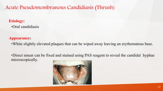 Acute Pseudomembranous Candidiasis (Thrush)
Etiology:
•Oral candidiasis
Appearance:
•White slightly elevated plaques that can be wiped away leaving an erythematous base.
•Direct smear can be fixed and stained using PAS reagent to reveal the candidal hyphae
microscopically.
27
 