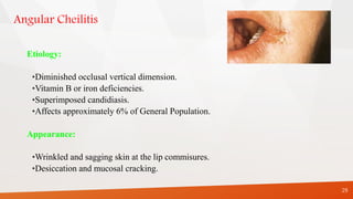 Angular Cheilitis
Etiology:
•Diminished occlusal vertical dimension.
•Vitamin B or iron deficiencies.
•Superimposed candidiasis.
•Affects approximately 6% of General Population.
Appearance:
•Wrinkled and sagging skin at the lip commisures.
•Desiccation and mucosal cracking.
29
 