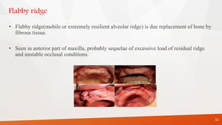 Flabby ridge
• Flabby ridge(mobile or extremely resilient alveolar ridge) is due replacement of bone by
fibrous tissue.
• Seen in anterior part of maxilla, probably sequelae of excessive load of residual ridge
and unstable occlusal conditions.
32
 