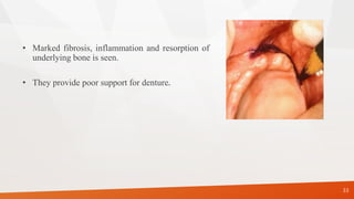 • Marked fibrosis, inflammation and resorption of
underlying bone is seen.
• They provide poor support for denture.
33
 
