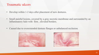 Traumatic ulcers
• Develop within 1-2 days after placement of new dentures.
• Small painful lesions, covered by a gray necrotic membrane and surrounded by an
inflammatory halo with firm , elevated borders.
• Caused due to overextended denture flanges or unbalanced occlusion.
35
 