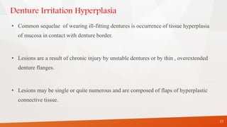 Denture Irritation Hyperplasia
• Common sequelae of wearing ill-fitting dentures is occurrence of tissue hyperplasia
of mucosa in contact with denture border.
• Lesions are a result of chronic injury by unstable dentures or by thin , overextended
denture flanges.
• Lesions may be single or quite numerous and are composed of flaps of hyperplastic
connective tissue.
37
 