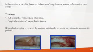 Inflammation is variable; however in bottom of deep fissures, severe inflammation may
occur.
Treatment
• Adjustment or replacement of denture.
• Surgical excision of hyperplastic tissues.
If lymphadenopathy is present, the denture irritation hyperplasia may simulate a neoplastic
process.
38
 