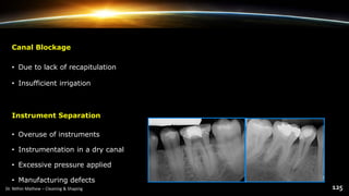 Canal Blockage
• Due to lack of recapitulation
• Insufficient irrigation
Instrument Separation
• Overuse of instruments
• Instrumentation in a dry canal
• Excessive pressure applied
• Manufacturing defects
 
