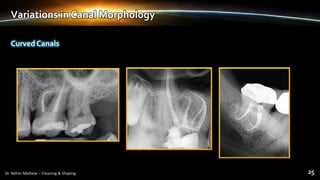 Variations in Canal Morphology
Curved Canals
 