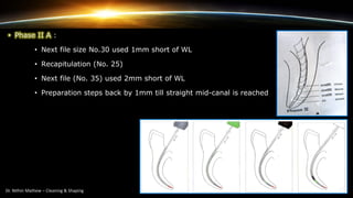 • Phase II A :
• Next file size No.30 used 1mm short of WL
• Recapitulation (No. 25)
• Next file (No. 35) used 2mm short of WL
• Preparation steps back by 1mm till straight mid-canal is reached
 