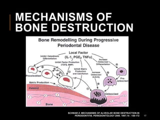 MECHANISMS OF
BONE DESTRUCTION
SCHWAR Z. MECHANISMS OF ALVEOLAR BONE DESTRUCTION IN
PERIODONTITIS. PERIODONTOLOGY 2000. 1997;14 : 158-172 17
 