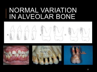 NORMAL VARIATION
IN ALVEOLAR BONE
22
 