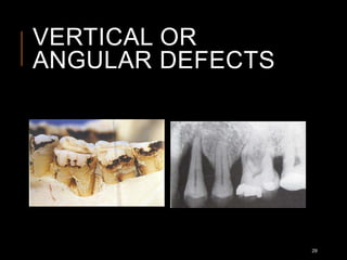 VERTICAL OR
ANGULAR DEFECTS
29
 