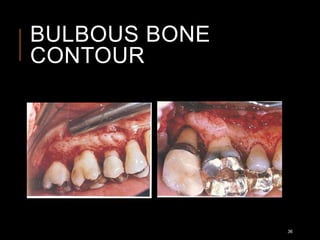 BULBOUS BONE
CONTOUR
36
 