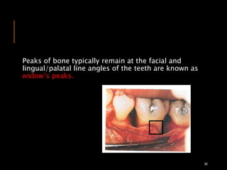 Peaks of bone typically remain at the facial and
lingual/palatal line angles of the teeth are known as
widow’s peaks.
38
 