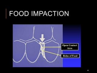 FOOD IMPACTION
46
 