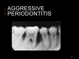 AGGRESSIVE
PERIODONTITIS
47
 
