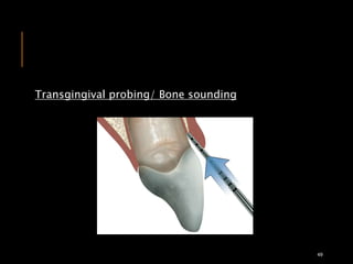 Transgingival probing/ Bone sounding
49
 