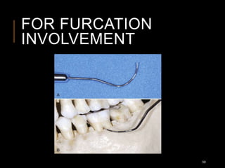 FOR FURCATION
INVOLVEMENT
50
 