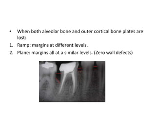 • When both alveolar bone and outer cortical bone plates are
lost:
1. Ramp: margins at different levels.
2. Plane: margins all at a similar levels. (Zero wall defects)
 