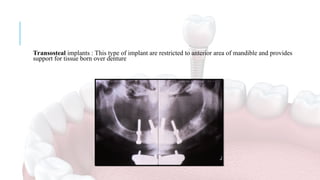 BASICS OF IMPLANTOLOGY- IMPLANT SURFACE TOPOGRAPHY COMPONENTS PARTS AND ...