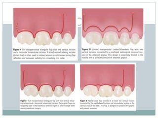 Apicectomy | PPTX
