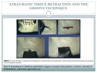 Apicectomy | PPTX