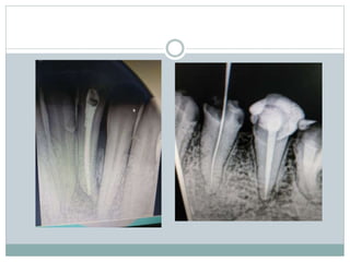Apicectomy | PPTX