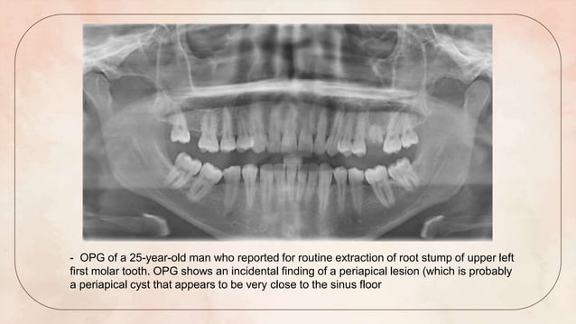 SEMINAR 13 - OAC AND OAF - introduction , surgical anatomy of maxillary ...