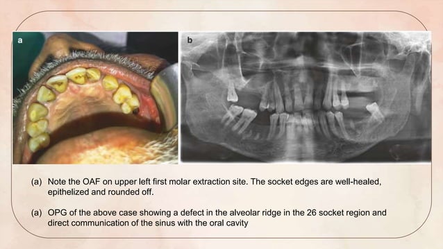 SEMINAR 13 - OAC AND OAF - introduction , surgical anatomy of maxillary ...