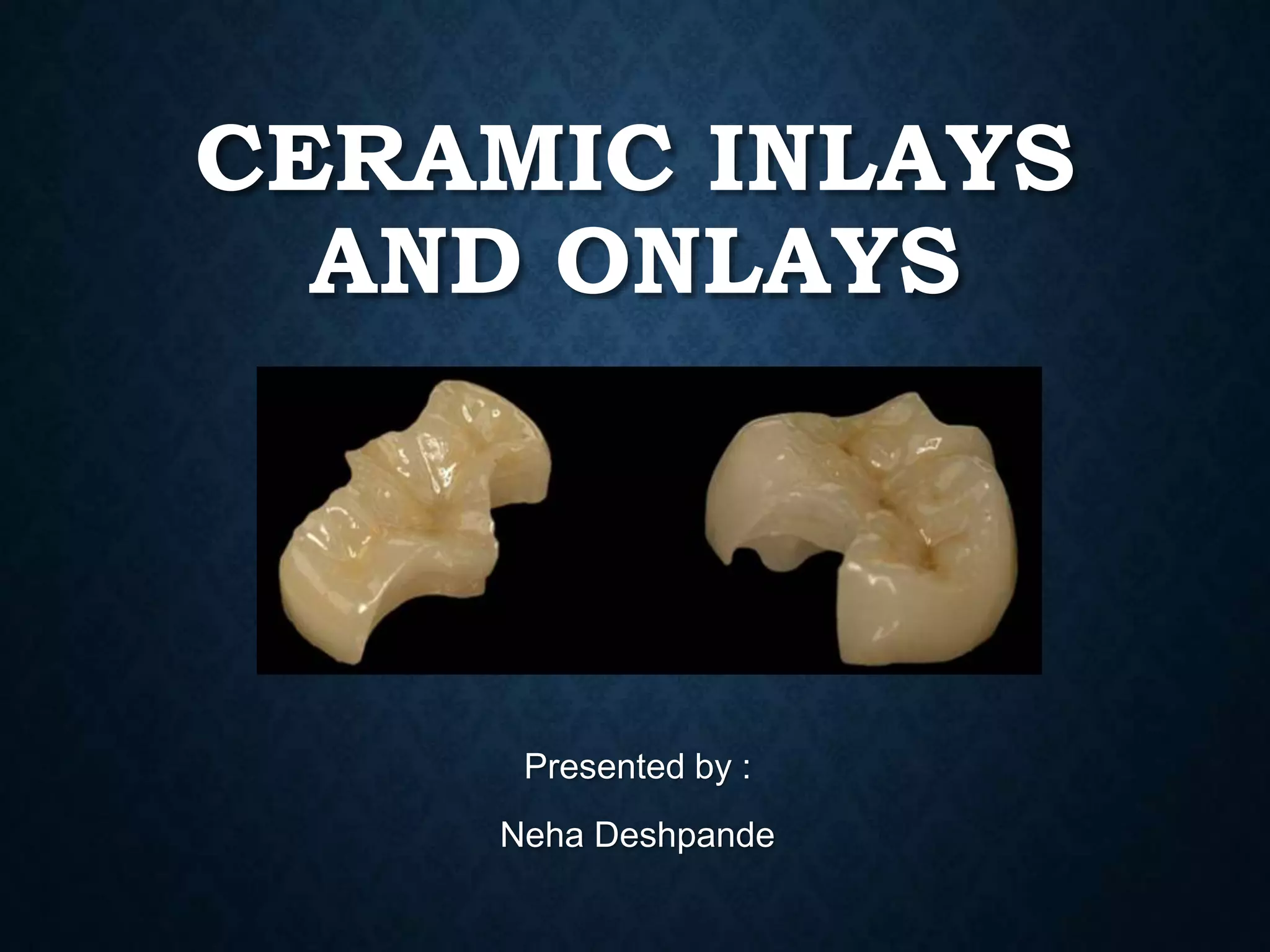 Ceramic inlays and onlays | PPTX