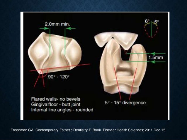 Ceramic Inlays And Onlays