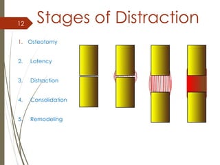 12 Stages of Distraction
1. Osteotomy
2. Latency
3. Distraction
4. Consolidation
5. Remodeling
 