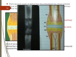 16
 From second week of distraction the osteoblasts lay down osteoid
tissue on these longitudinally oriented collagen fibres and primary
bone trabeculae begins to form
Mineralization (MZ)-
longitudinally oriented primary
osteons
Fibrous radiolucent inter-zone
(FZ)-
longitudinally oriented
collagen bundles
End of second week osteoid begins to mineralize at that time,
distraction regenerate has specific three zonal structure ( simultaneously
representing a two stage of# healing  soft & hard callus
 