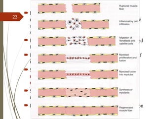 23
 Finally progressive distraction may over come the
resistance of the tissue resulting in local degenerative
and necrotic changes of muscle fiber followed by
separation of two parts of the muscle fibre
 Regenerative process occurs at the end of the ruptured
fibre
 Inflammatory cells immediately migrate to the site of
injury
 Satellite cells proliferate& migrate next providing a
new generation of myoblast  which fuses to form
new myofibrils
 Synthesis of myofibrillar proteins completes the
restoration of the injured muscle fibre
 Later rapid proliferation of fibroblastic cell population
 