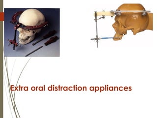 30
Extra oral distraction appliances
 