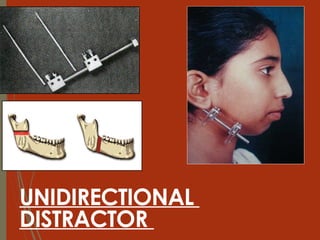 32
UNIDIRECTIONAL
DISTRACTOR
 