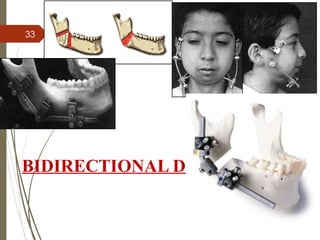 33
BIDIRECTIONAL DISTRACTOR
 