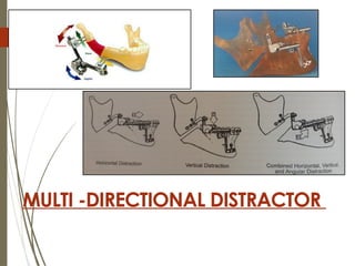 34
MULTI -DIRECTIONAL DISTRACTOR
 