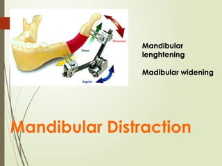 41
Mandibular Distraction
Mandibular
lenghtening
Madibular widening
 