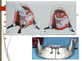 44
 Intraoperative distraction:
 Once osteotomy and sectioning is complete
 Appliance is carefully activated to produce immediate expansion
of mand arch
 Achieve 2mm of opening
 Streching gingival interdental tissue determine amount of
expansion- blanching indicates stop (1-1.5mm)
 Layered closure of surgical wound

 