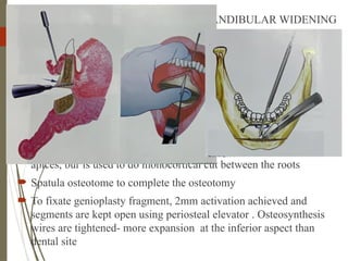 46
 COMBINED GENIOPLASTY AND MANDIBULAR WIDENING
 Once soft tissue reflected, channel retractor placed through a tunnel
underneath mental nerve to first molar- reference marks are made
 Reciprocating saw is used to perform bicortical osteotomy at
inferior border, 5mm away from apices- horizontally
 Maintain soft tissue pedicled to osteotomised segment (periosteal
reflection minimal)
 Vertical osteotomy at the preselected site up to level of dental
apices, bur is used to do monocortical cut between the roots
 Spatula osteotome to complete the osteotomy
 To fixate genioplasty fragment, 2mm activation achieved and
segments are kept open using periosteal elevator . Osteosynthesis
wires are tightened- more expansion at the inferior aspect than
dental site
 