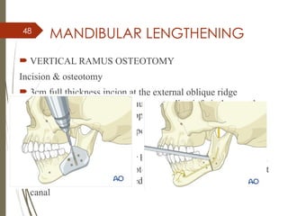 48
MANDIBULAR LENGTHENING
 VERTICAL RAMUS OSTEOTOMY
Incision & osteotomy
 3cm full thickness incion at the external oblique ridge
midway upto ascending ramus, extending inferiorly over the
alveolar ridge to position opp first and second molar
 Subperiosteal tunneling- expose buccal cortex, angle and
alveolar ridge
 Channel retractor at inferior border between 2nd
and 3rd
molar,
saw is used to etch the osteotomy and transect cortical bone at
the inferior border. Sectioned upto 3mm of inferior alveolar
canal
 