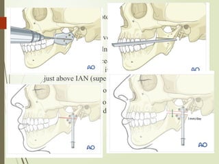 50
Horizontal ramus osteotomy
 3cm full thickness over mandibular oblique ride
 Subperiosteal tunnelng to expose buccal cortex
 Kelley clamp is placed in anterior border of ramus as
high as possible and inferior border retractor is placed
just above IAN (superior to lingula)
 Saw to perform osteotomy- posterior to anterior
 Preselected distraction device is placed and
osteotomy complated
 