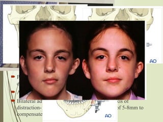 52 Sagittal distraction
osteogenesis
 Standard saggital split osteotomy is performed, maintaining
IAN in distal segment(Bsso is modified to short oblique
sagittal cut and lesser overlap (gives min bony interference
btwn proximal and distal segments))
 Intermediate splint is used IMF applied
 Proximal segment fixation with bisortical screw is
established and distraction device is transmucosally placed
 Adequate device stability- remove bicotical screws
 Bilateral advancement- distractor parallel to axis of
distraction- adjustment of the appliance- step of 5-8mm to
compensate for variation in mand width
 