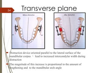54 Transverse plane
 Distraction device oriented parallel to the lateral surface of the
mandibular corpus  lead to increased intercondylar width during
distraction
 The magnitude of this increase is proportional to the amount of
lengthening and to the mandibular arch angle
 