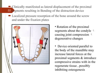 55
 Clinically manifested as lateral displacement of the proximal
segments resulting in Bending of the distraction device
 Localized pressure resorption of the bone around the screw
and under the fixation plates
• Rotation of the proximal
segments about the condyle 
causing joint compression 
degenerative changes
• Device oriented parallel to
the body of the mandible may
increase lateral forces at the
proximal segments & introduce
compressive strains with in the
regenerate tissue , possibly
inhibiting osteogenesis
 