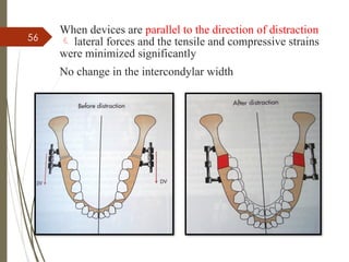 56
When devices are parallel to the direction of distraction
 lateral forces and the tensile and compressive strains
were minimized significantly
No change in the intercondylar width
 