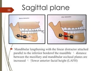 58 Sagittal plane
 Mandibular lengthening with the linear distractor attached
parallel to the inferiior borderof the mandible  distance
between the maxillary and mandibular occlusal planes are
increased  ↑lower anterior facial height (LAFH)
 