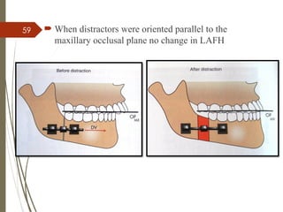 59  When distractors were oriented parallel to the
maxillary occlusal plane no change in LAFH
 