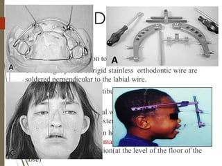 64 R E D DEVICE
External halo frame
Intra oral splint
 In order to apply traction to the maxilla through the dentition
 Two straight pieces of rigid stainless orthodontic wire are
soldered perpendicular to the labial wire.
 short end towards the vestibule that eventually will be used as
intraoral hooks.
 The long end of the vertical wire is marked while the device is
in the mouth to bend the external traction hooks
 Before bending the traction hooks, transfer the approximate
center of resistance of the maxilla from the cephalometry and
from the clinical examination(at the level of the floor of the
nose)
 
