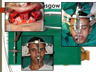 66
The Glasgow extra-oral
distraction (GED) device
a cranialfixation component (halo-frame )
a vertical connector with activating and
locking Nuts
an anterior horizontal connection rod with
activating and locking nut
an intra-oral splint on to which a locking plate
has been soldered.
 